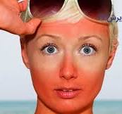 آفتاب سوختگی پوست در اثر اشعه uv خورشید